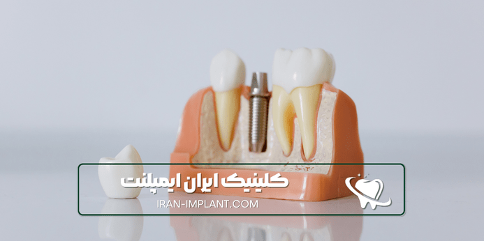 مراحل ایمپلنت دندان با بیهوشی