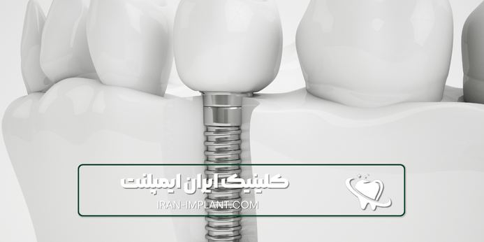 ایمپلنت با بیهوشی کامل برای چه کسانی مناسب است