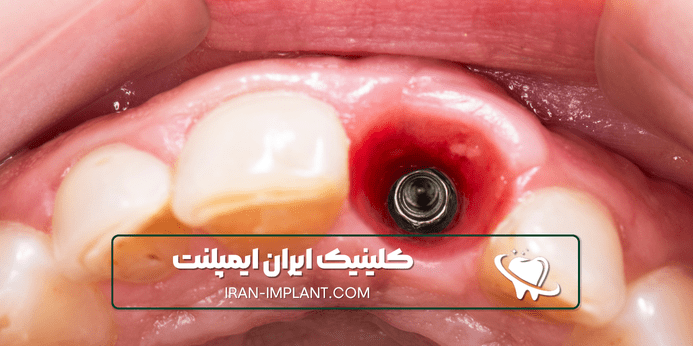 مراقبت های پس از بیهوشی ایمپلنت چیست