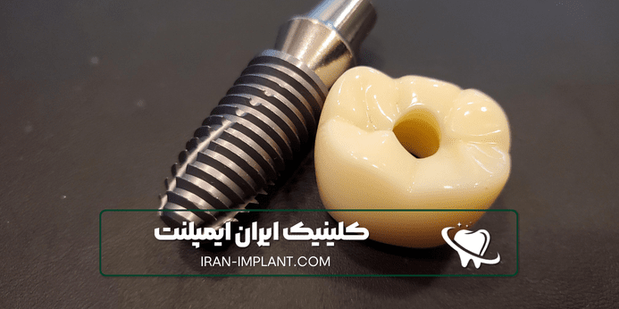 نکاتی که باید قبل از ایمپلنت با بیهوشی رعایت کنیم