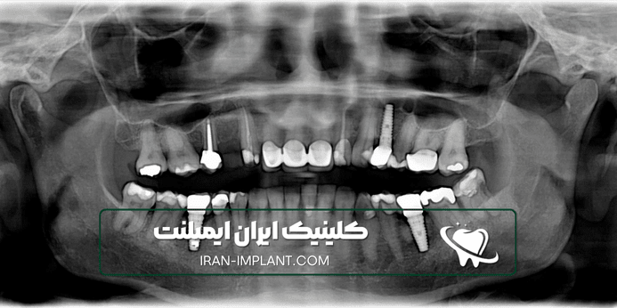 چرا برای ایمپلنت دندان با بیهوشی کامل ایران ایمپلنت را انتخاب کنید