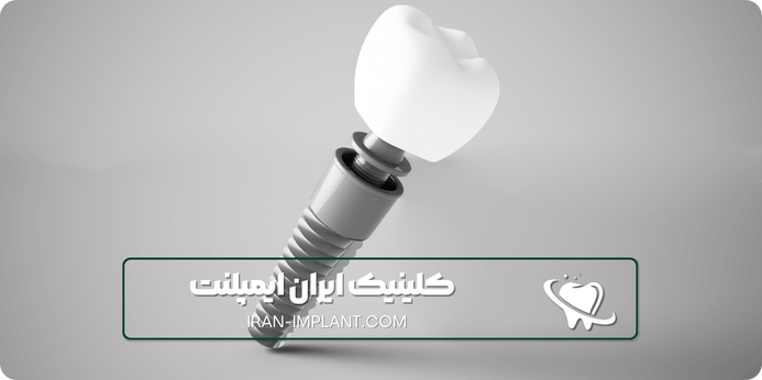 ایمپلنت کره ای چیست