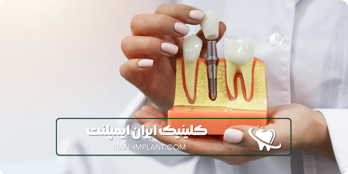 بهترین ایمپلنت کره ای