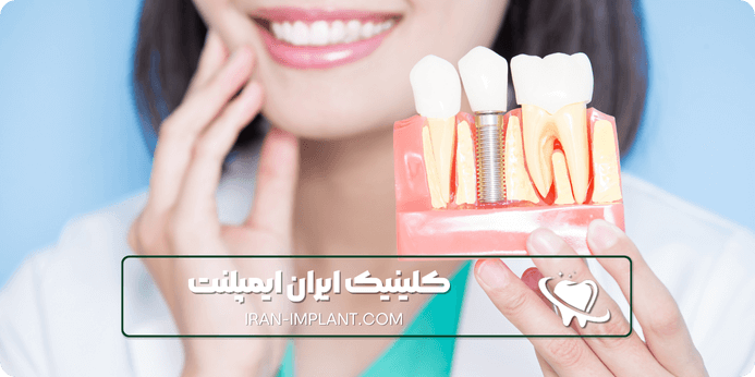 ویژگی ها و مشخصات ایمپلنت کره ای