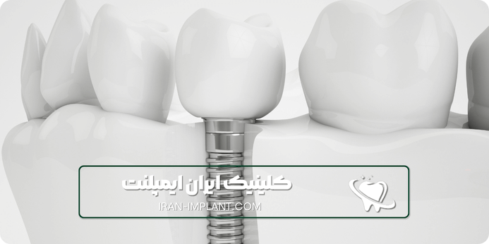 مراقبت های پس ایمپلنت کره ای