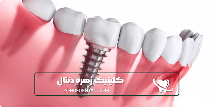 چرا ایمپلنت اقساطی در ستارخان زهره دنتال