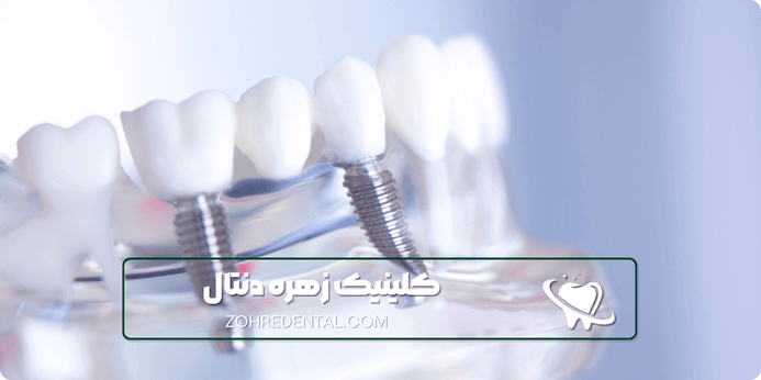 مراحل ایمپلنت اقساطی ستارخان