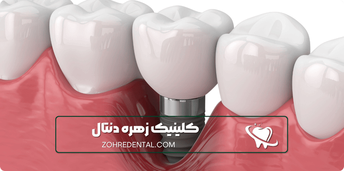 مزایای ایمپلنت اقساطی