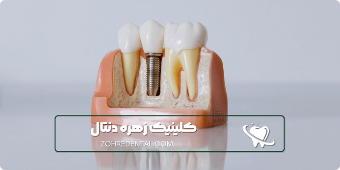ایمپلنت با بیهوشی کامل چیست
