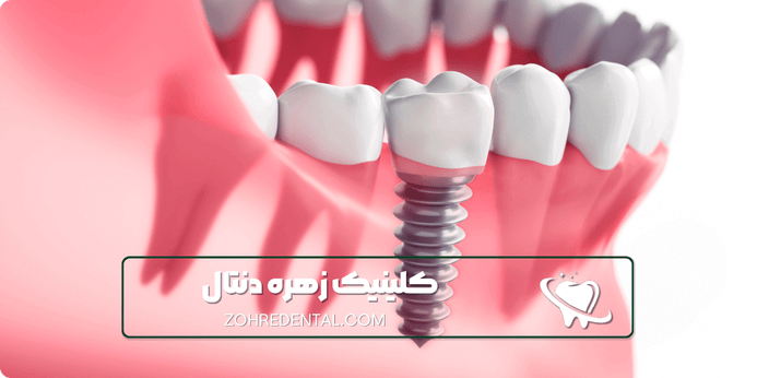 ایمپلنت با بیهوشی کامل برای چه کسانی مناسب است