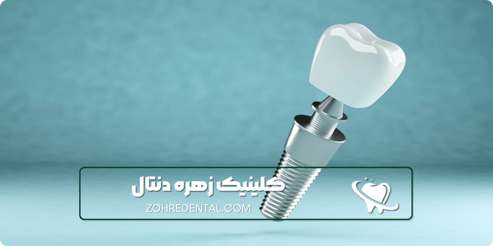 مزایای ایمپلنت دندان با بیهوشی کامل چیست