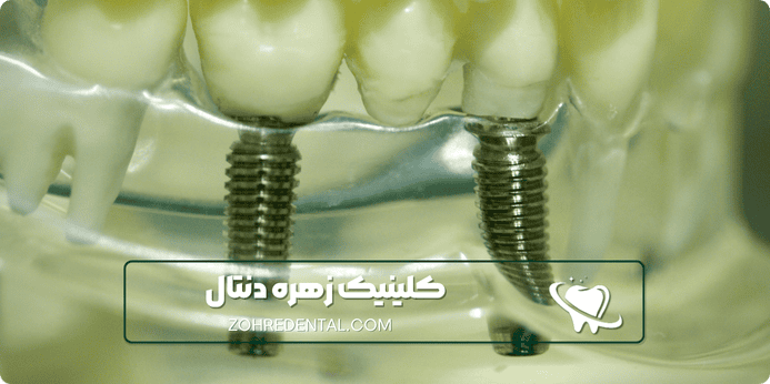 عوارض ایمپلنت با بیهوشی کامل چیست