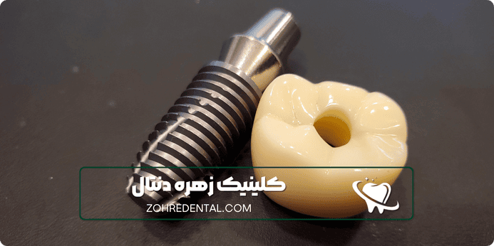 نکاتی که باید قبل از ایمپلنت با بیهوشی رعایت کنیم