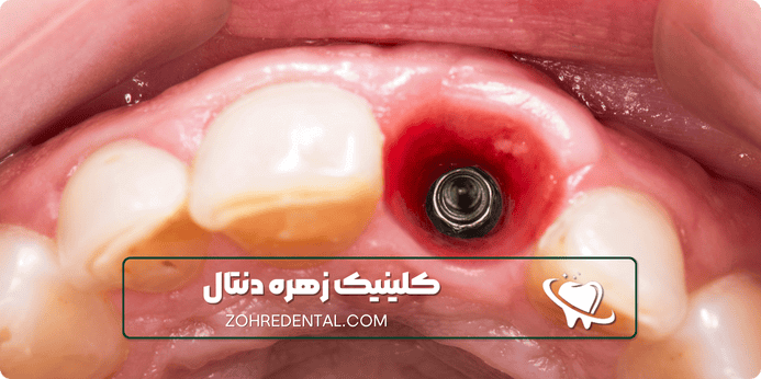 مراقبت های پس از بیهوشی ایمپلنت چیست