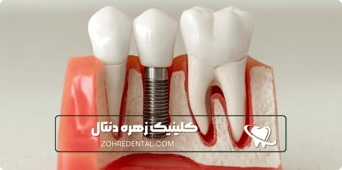 معایب ایمپلنت دندان با بیهوشی کامل چیست