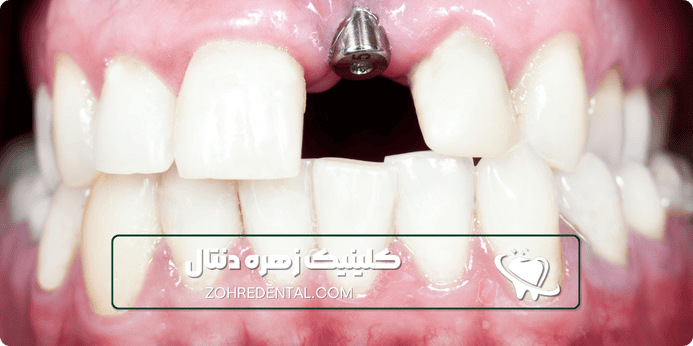 چرا برای ایمپلنت دندان با بیهوشی کامل (زهره دنتال) را انتخاب کنید؟