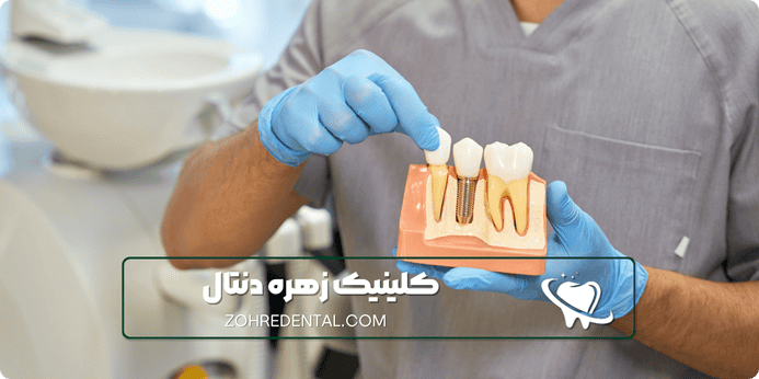 پوشش بیمه ها برای ایمپلنت