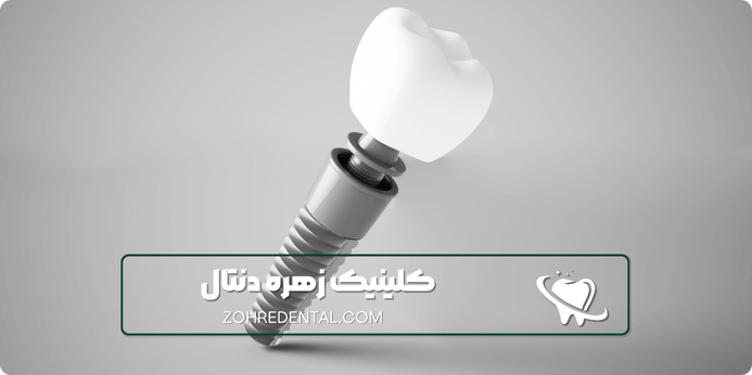 بهترین بیمه تکمیلی برای ایمپلنت دندان