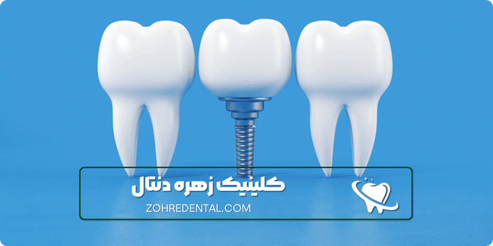 پرداخت هزینه ایمپلنت دندان با بیمه