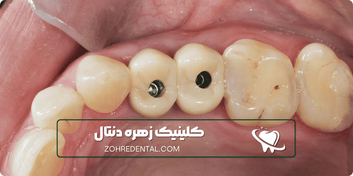 ایمپلنت کره ای چیست
