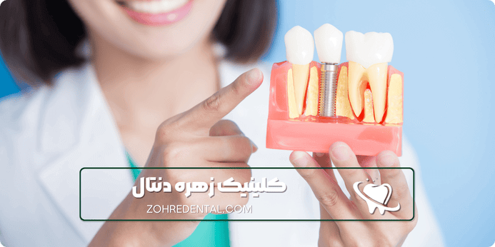 ویژگی ها و مشخصات ایمپلنت کره ای