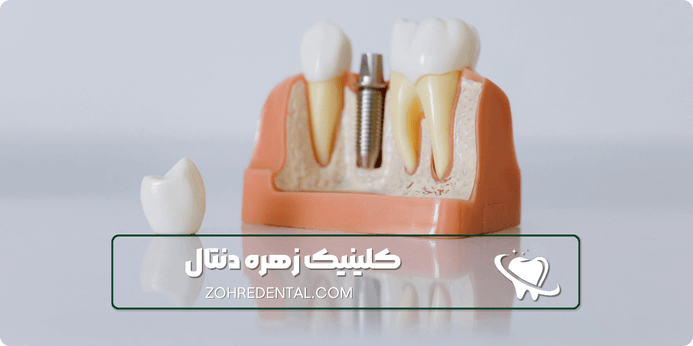 مراقبت های پس ایمپلنت کره ای