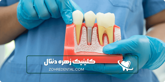 تفاوت ایمپلنت کره ای با دیگر ایمپلنت ها