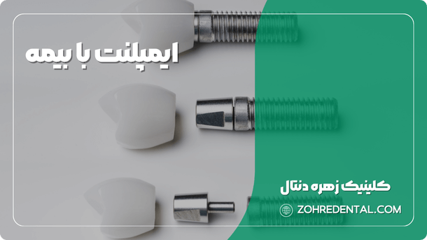 ایمپلنت با بیمه