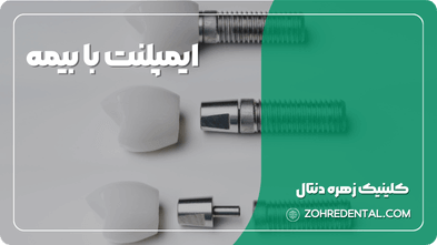 ایمپلنت با بیمه