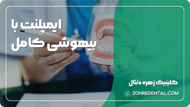ایمپلنت با بیهوشی کامل