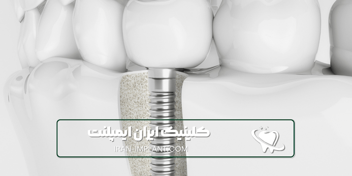 عوامل موثر بر قیمت ایمپلنت اقساطی تهران