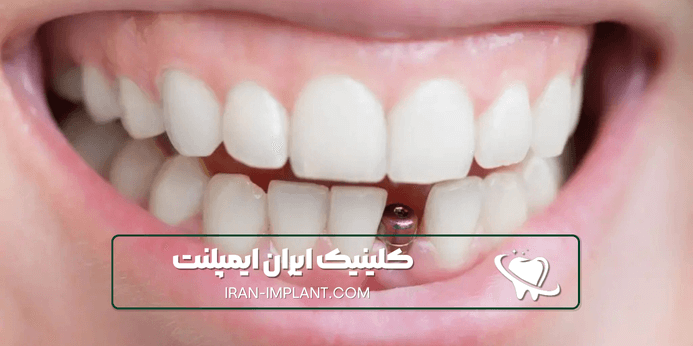 چگونه بهترین پزشک ایمپلنت در ستارخان را پیدا کنیم