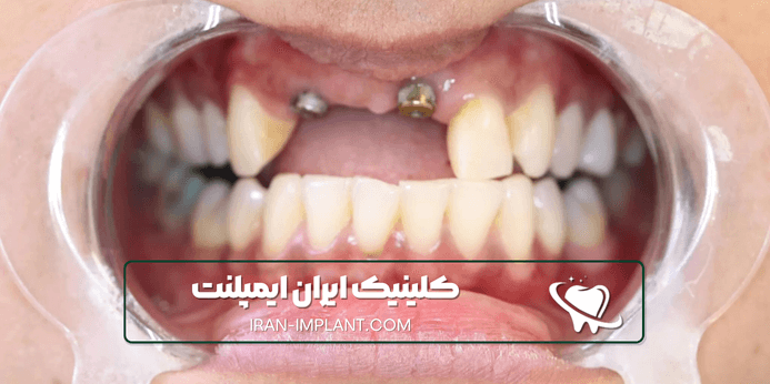 مزایای ایمپلنت اقساطی