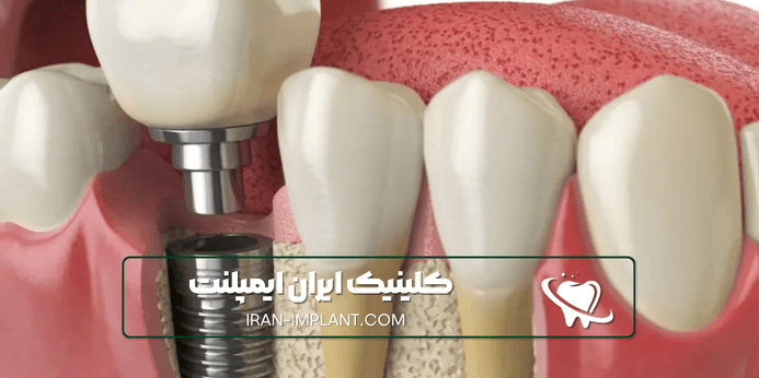 مراحل ایمپلنت اقساطی ستارخان