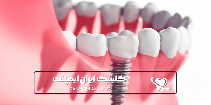 چرا ایمپلنت اقساطی در ستارخان ایران ایمپلنت