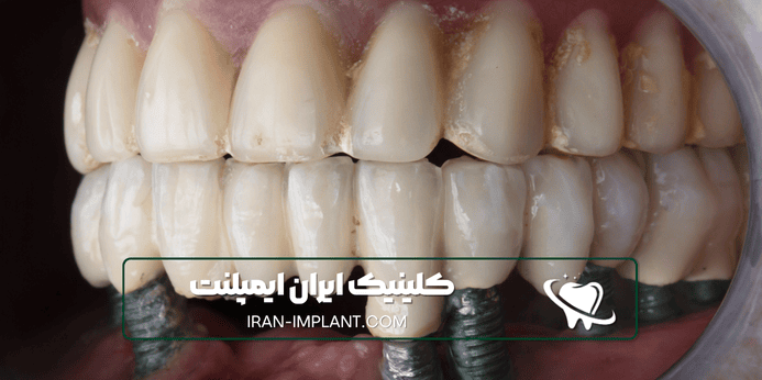 مراقبت های بعد از ایمپلنت دندان