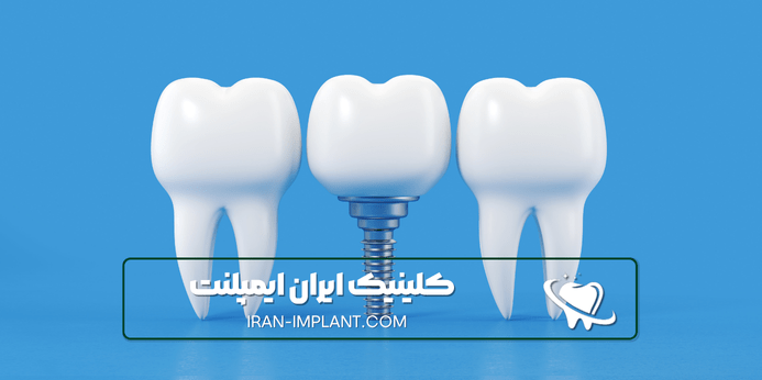 مزایای ایمپلنت اقساطی