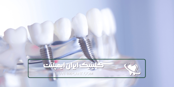 نکاتی که باید قبل از انجام ایمپلنت اقساطی بدانید