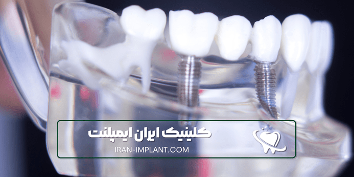 چالش های ایمپلنت دندان