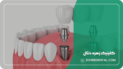 هزینه ایمپلنت با بیمه تکمیلی آسیا
