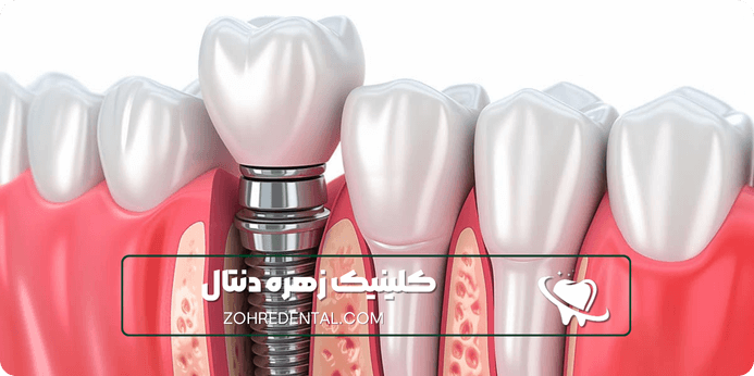 هزینه ایمپلنت با بیمه تکمیلی آسیا چه شرایطی دارد
