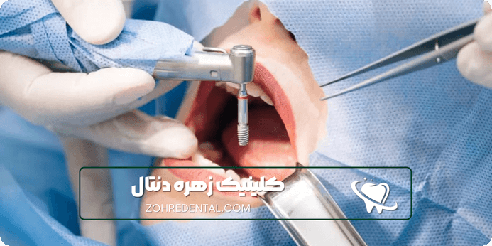 مراحل و نکات قبل از انجام ایمپلنت با بیمه آسیا