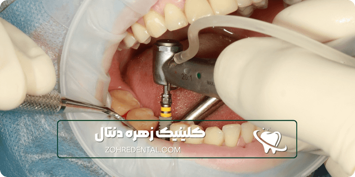 بیمه آسیا برای ایمپلنت چه خدماتی را پوشش میدهد