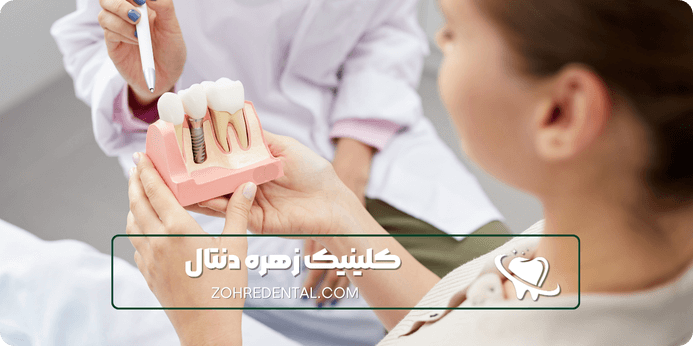 ایمپلنت برای چه کسانی مناسب است