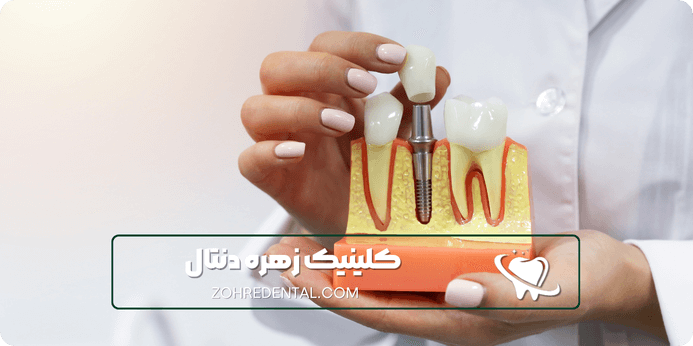 مراحل تشخیص مناسب بودن برای ایمپلنت