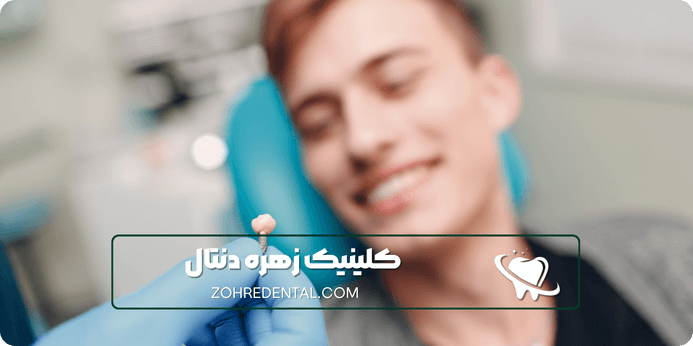 قیمت ایمپلنت در تهران