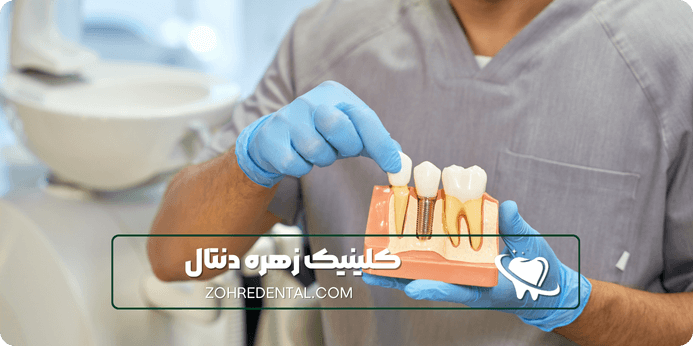هزینه ایمپلنت با بیمه تکمیلی البرز چه شرایطی دارد