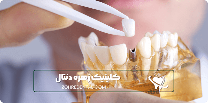 مراحل انجام ایمپلنت با بیمه البرز چطوری پیش میره