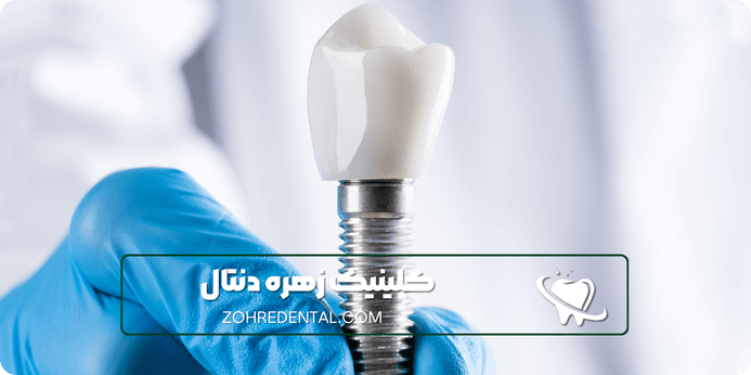 مزایای استفاده از بیمه البرز برای ایمپلنت