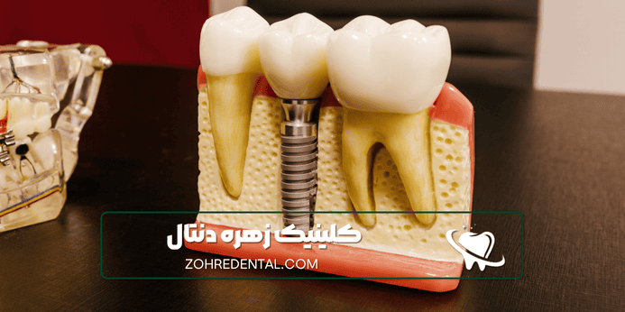 هزینه ایمپلنت دندان به چه مواردی وابسته است